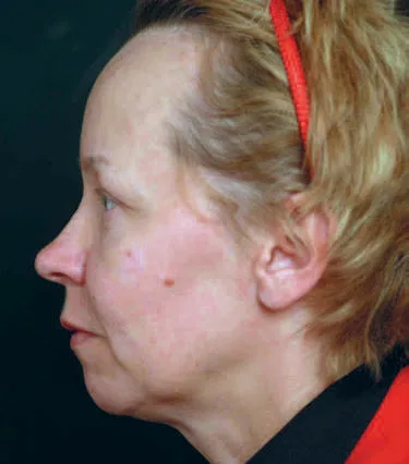 Fig 7. Microgenia on profile - short hyoid-to-mentum distance and a deep prejowl sulcus