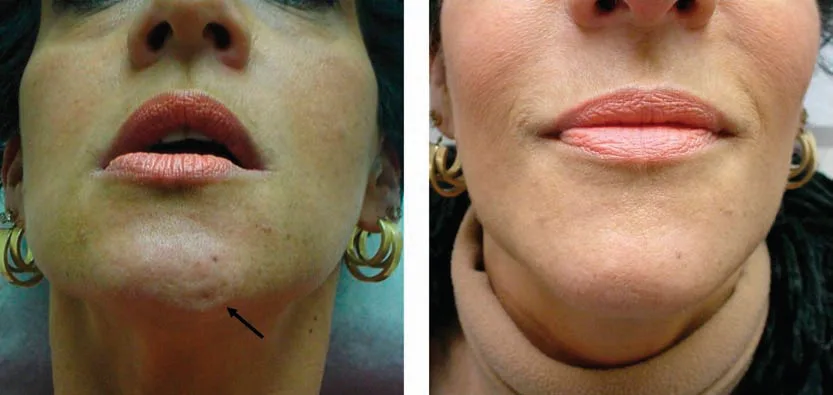 Fig 12. Chin dimpling before and after onabotulinumtoxinA to the mentalis