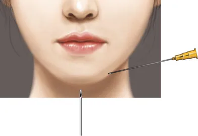Fig 8. Chin augmentation - midline needle to bone plus a lateral entry