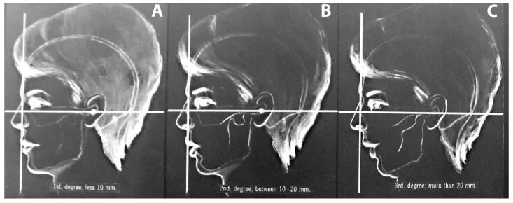 Fig 4. González-Ulloa chin-retrusion degrees against the zero-meridian