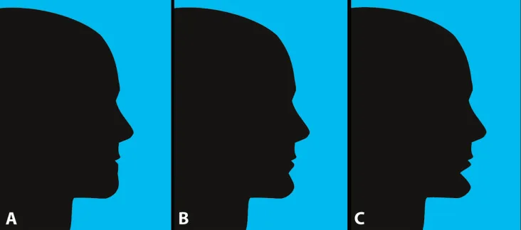 Fig 5. Mentolabial fold morphology at a constant sagittal chin position