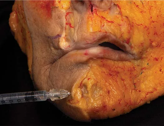 Fig 11. Mentalis toxin - deep perpendicular injection, cadaver field