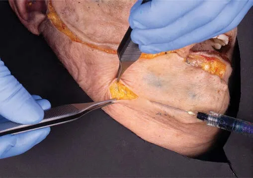 Fig 10. Subcutaneous "parallel" cannula plane - the alternative to needle-to-bone