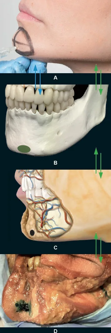 Fig 9. Supraperiosteal needle-to-bone technique, cadaver-verified
