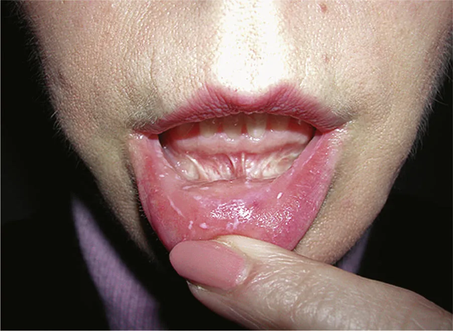 Fig 6. Dynamic exam - lower-lip retraction to read the mentalis-lip complex and lip competence