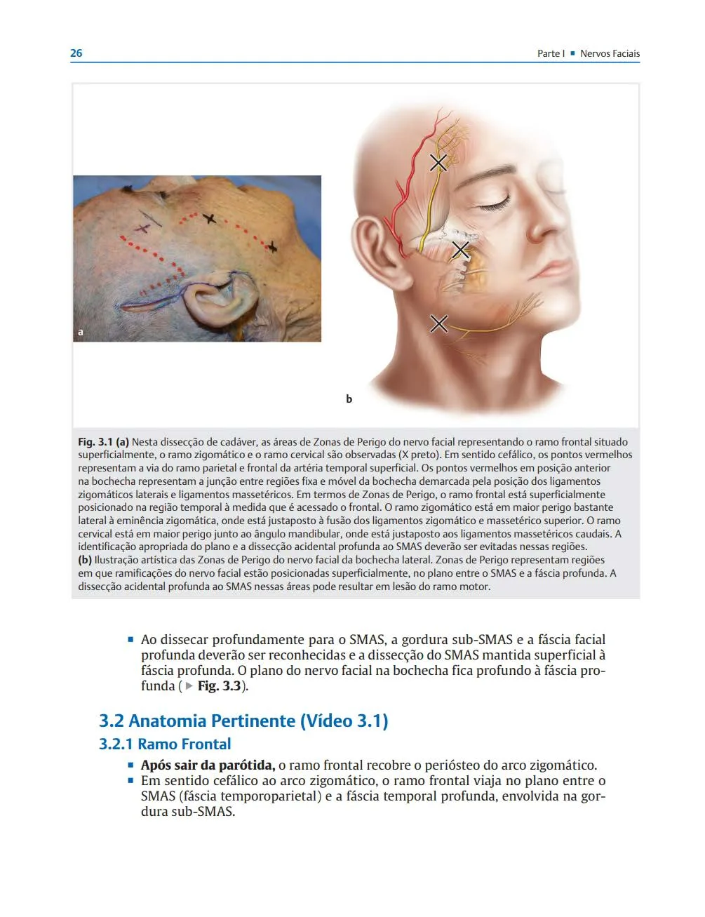 Fig 3. Cadaveric dissection and artist's rendering of the facial-nerve danger zones of the lateral face: frontal, zygomatic and cervical branches marked, the cervical branch at greatest risk at the mandibular angle where it lies superficially between SMAS and deep fascia.