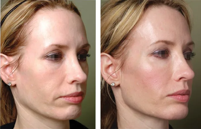 Fig 8. Before and after oblique photographs of lower-face contouring with filler from the gonial angle to the chin, showing a restored continuous border and softened jowl.