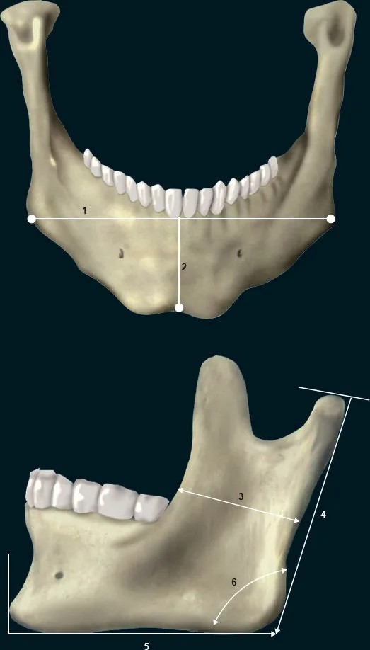 Fig 6. Isolated mandible in frontal and lateral views with the quantitative landmarks: bigonial width, mandibular body height, ramus dimensions and the gonial angle.