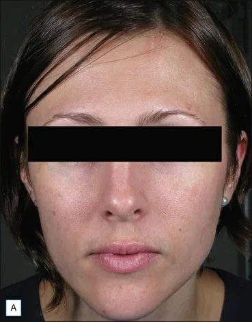 Fig 9. Frontal clinical photograph of a patient with masseteric hypertrophy widening the lower third of the face (pre-treatment baseline for masseter toxin).