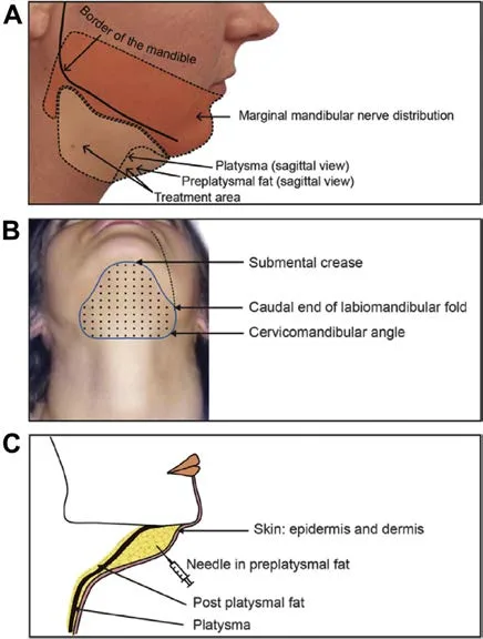 Fig D13-10. Deoxycholic-acid technique, three panels: (A) the marginal mandibular nerve distribution and the sagittal position of platysma/preplatysmal fat relative to the treatment area; (B) the submental view with the dotted 1-cm injection grid inside the marked boundaries; (C) the sagittal cross-section with the needle placed in the preplatysmal fat, deliberately superficial to the platysma and the post-platysmal fat.