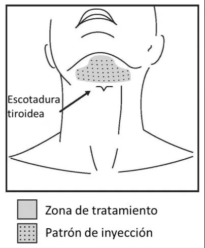 Fig D13-11. Submental treatment-zone schematic: the shaded "zona de tratamiento" with its dotted injection pattern is kept above the thyroid notch (escotadura tiroidea). The same superior-to-the-thyroid-cartilage rule that bounds fat-dissolving injection also bounds neck toxin (D13.8).