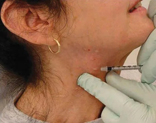 Fig D13-12. Platysmal-band toxin: the band is grasped between the fingers of the non-dominant hand and the toxin injected superficially inside the pinched fold along the lateral neck. The pinch keeps the needle out of the deep plane where the strap muscles lie.
