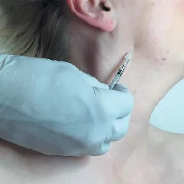 Fig D13-13. Nefertiti-lift placement: superficial injections along the upper cervical border of the platysma just inferior to the mandible, posterior to the DAO and anterior to the SCM. Relaxing the platysma's downward pull lets the facial levators redrape the jawline.