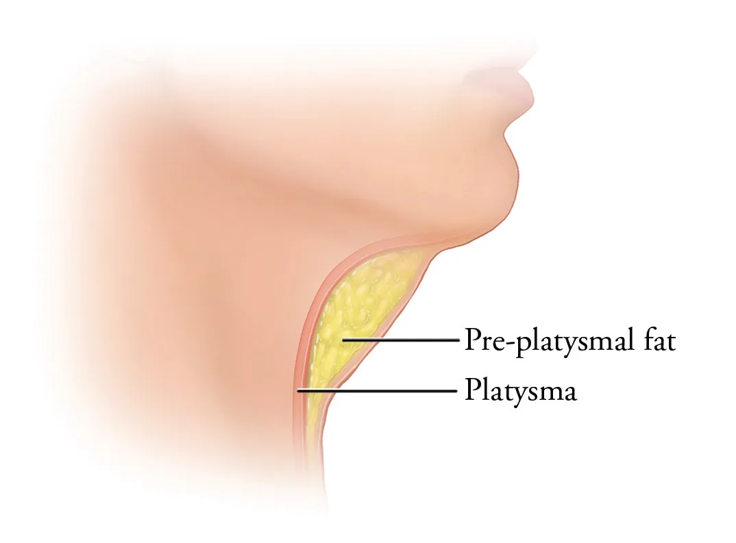 Fig D13-1. Lateral cross-section of the submental region: the pre-platysmal (superficial) fat sits directly on the platysma sheet. This is the plane the deoxycholic-acid needle must stay within; the subplatysmal fat and strap muscles lie deep to the platysma and are a surgical, never an injectable, target.