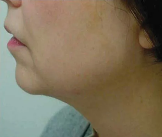 Fig D13-7. Lateral profile, the mandatory neck view: soft submental fullness blunts the cervicomental angle. The profile integrates chin projection, hyoid position and submental fat into the single number (the angle) that predicts the non-surgical ceiling.