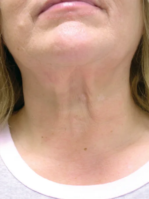 Fig D13-8. Frontal view of an ageing neck: vertical platysmal bands, horizontal necklace lines and skin laxity coexist. Each is a different diagnosis (toxin, dermal biostimulation/booster, energy/surgery), which is why the frontal exam must name all three, not "the neck".