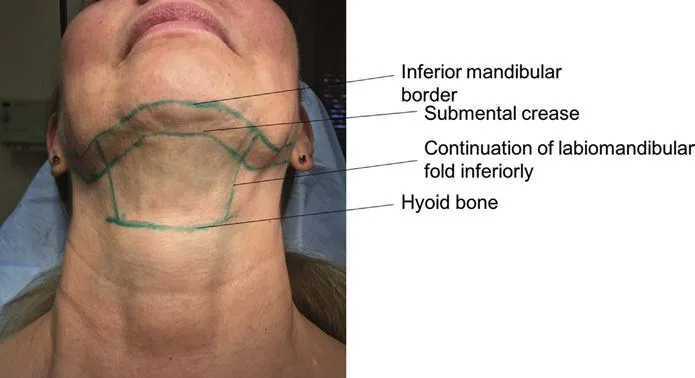 Fig D13-9. Deoxycholic-acid field marking on the patient: the treatment area is bounded by the submental crease (superior), the caudal continuation of the labiomandibular fold (lateral) and the hyoid bone (inferior). The strip between the mandibular border and the submental crease is deliberately spared, the marginal-mandibular no-treatment zone.