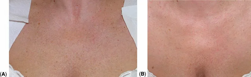 Fig 2. IPL photorejuvenation of the chest (A) before: mottled pigment + telangiectasia in the V; (B) after: cleared pigment and vascular components.