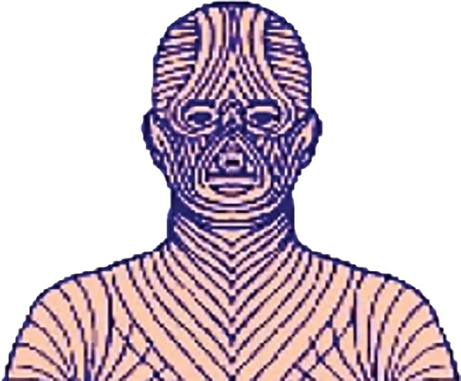 Fig 3. Skin tension (Langer's) lines; note the high-tension V converging over the sternum, the mechanical basis of the chest's keloid predisposition.