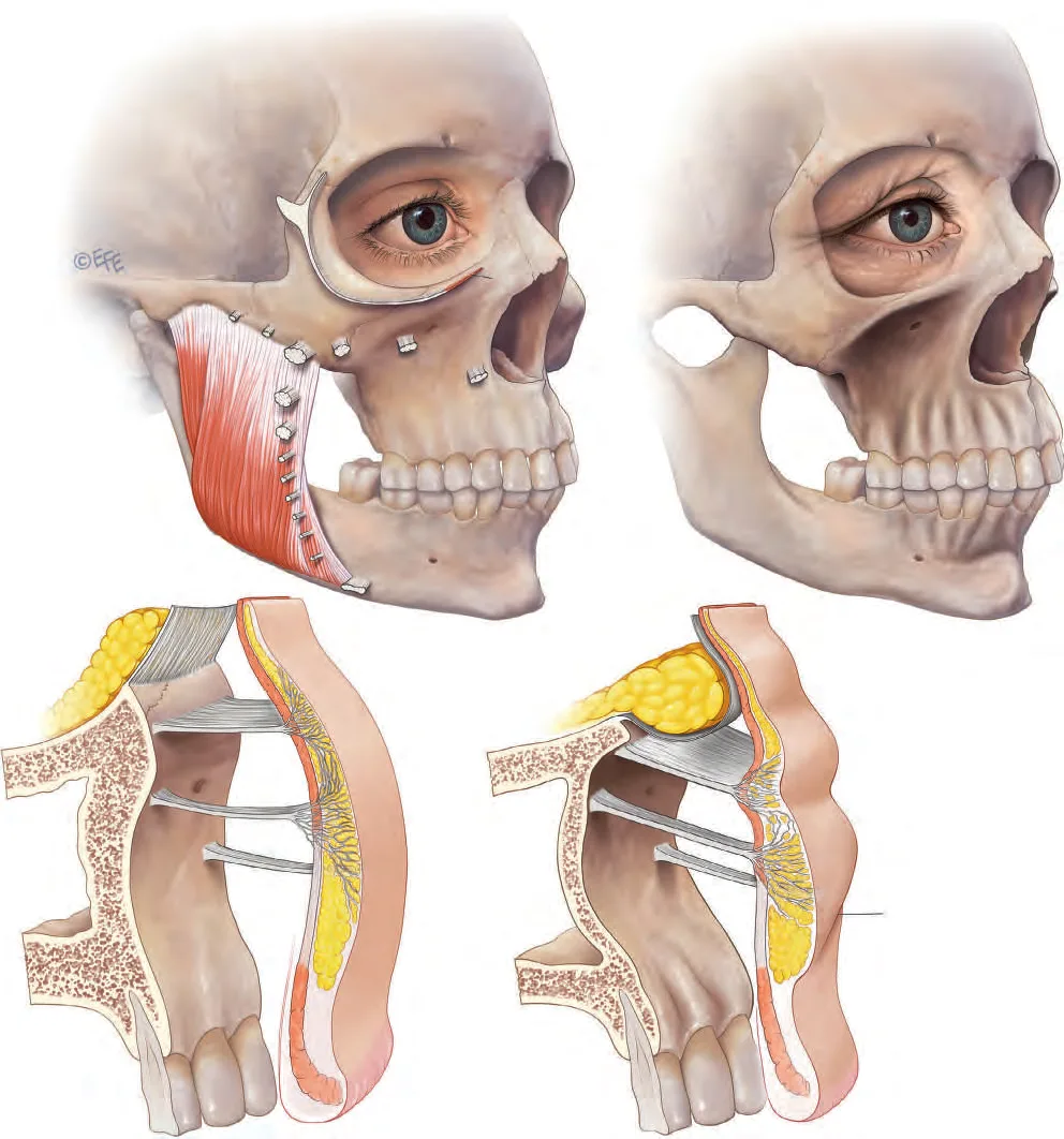 Fig 1. Facial layered-ageing cascade (bone→deep fat→muscle→skin), shown as the deep-structure model that does NOT operate on the chest.