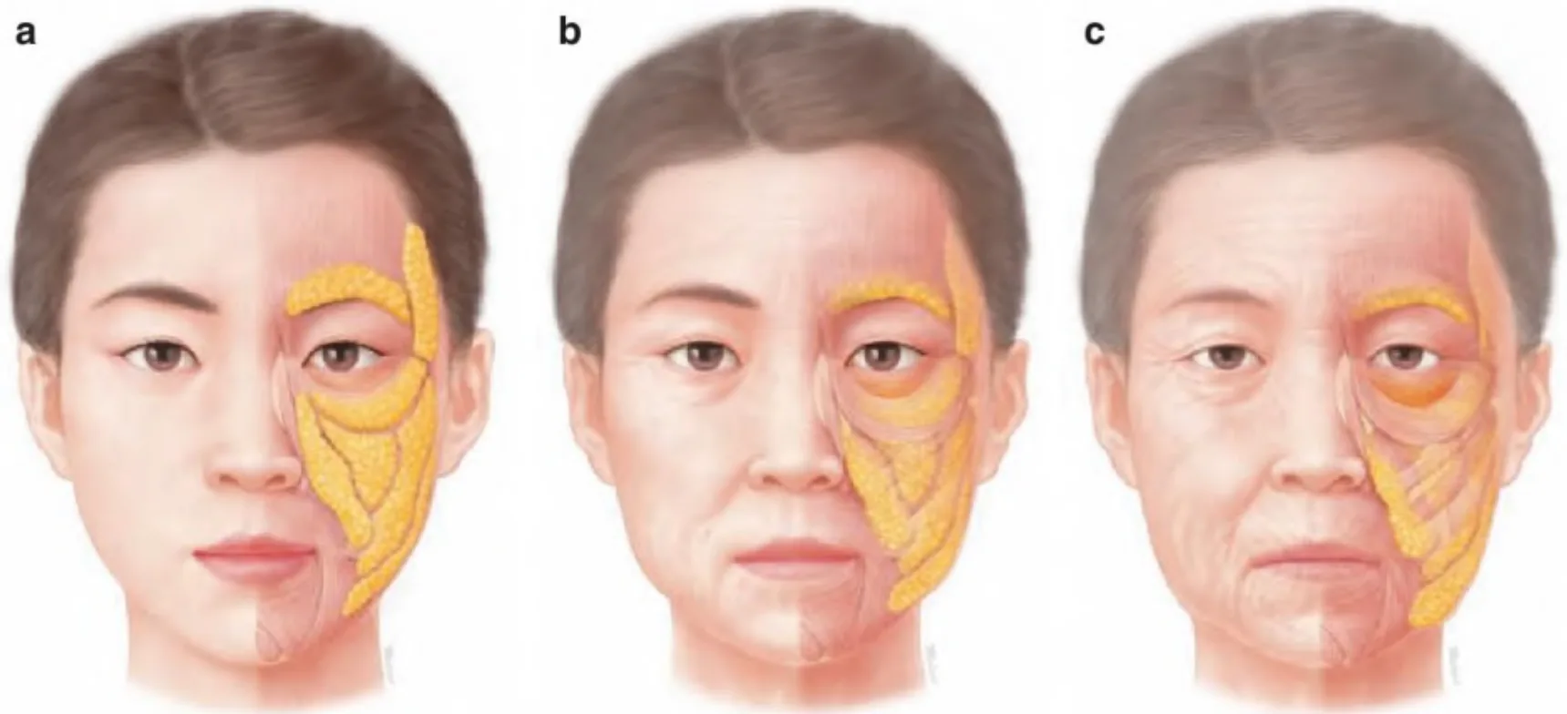 Fig 11. Progressive facial ageing (young → middle → old): superficial fat compartments (yellow) deflate and descend while rhytids and skin change appear last.