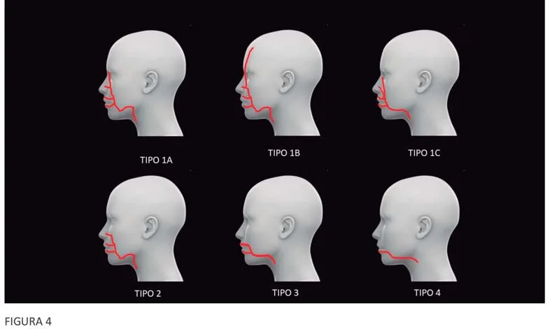 Fig 7. Facial-artery branching variants (types 1A-4) from the complications teaching deck - the point is that surface landmarks predict a *population*, not the patient in the chair.