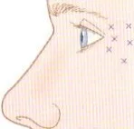 Fig 12. Lateral canthal / lateral orbicularis injection pattern (X marks) at the tail of the brow - the surface target of the chemical brow-tail lift.
