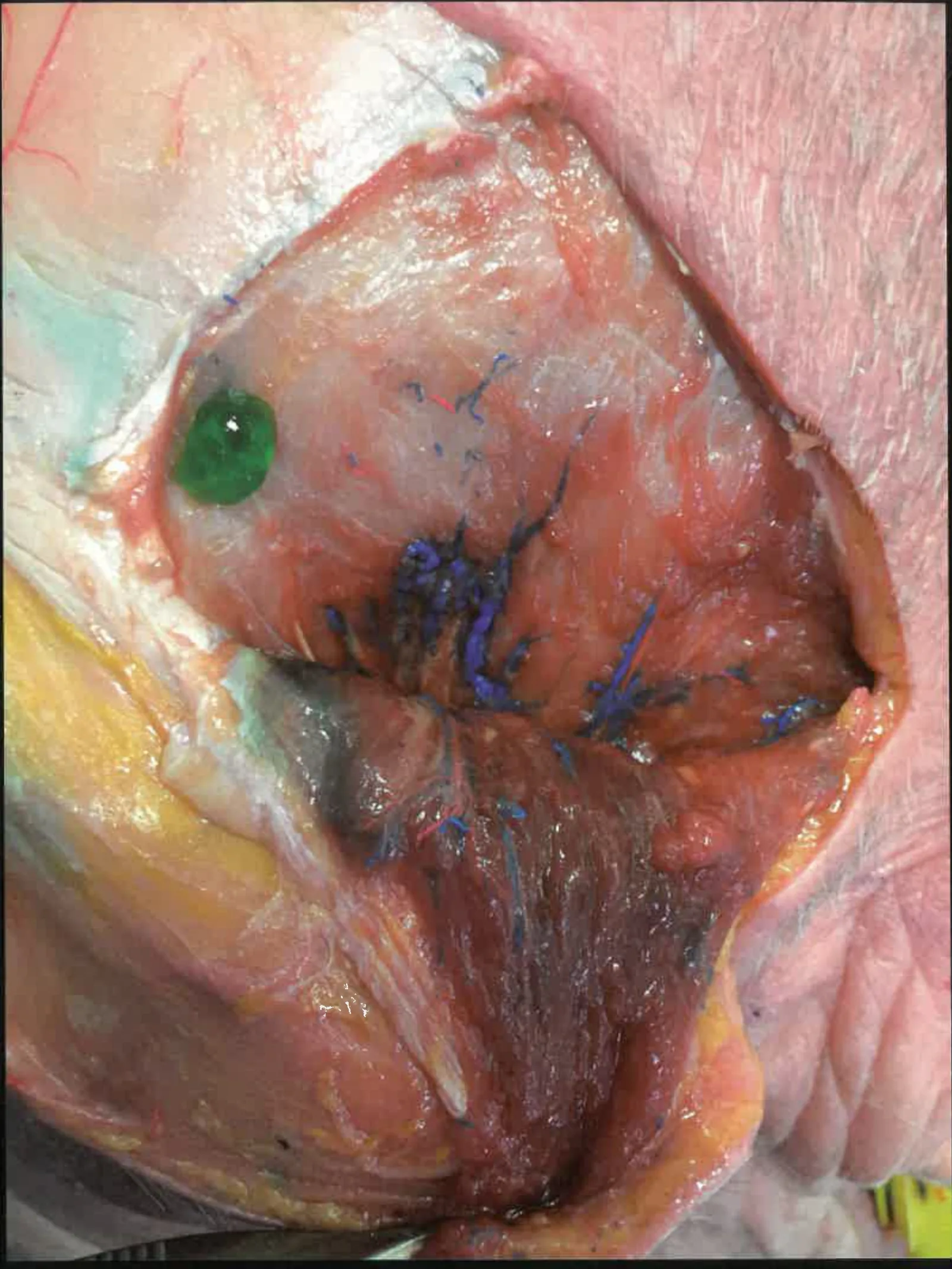 Fig 4. Cadaver dissection of the temporal region showing the exposed fascial and muscular layers with dye-marked vessels, confirming the separable superficial/deep temporal fascia planes.