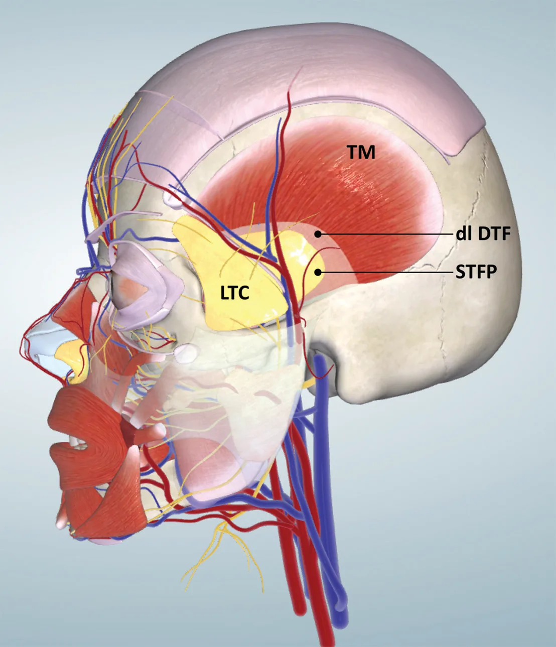 Fig 3. Lateral 3D model of the temple: temporalis muscle (TM), the deep lamina of the deep temporal fascia (dl DTF) and the superficial temporal fat pad (STFP) it encloses, with the lower temporal compartment (LTC, yellow) between the fascial leaves.