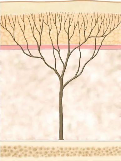 Fig 4. Schematic of a facial retaining-ligament fibre bundle running from periosteum through the fat and muscle to insert into the dermis; these adhesions are strong over the brow and orbit and set the boundaries a bolus cannot cross.
