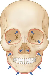 Fig 8. Frontal skull with arrows marking the bone-resorption vectors of ageing: the orbital aperture widens superomedially and inferolaterally, the pyriform and maxilla recede, and the mandibular angle changes.