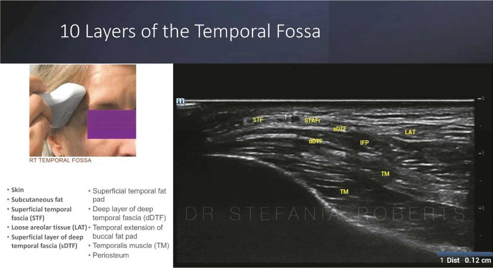 Fig 11. Ultrasound layer identification of a facial region (temporal fossa shown): probe placement and the labelled B-mode image resolving skin, fascia, fat pads and muscle down to bone; the same technique maps the periorbital vessels and planes before injection.