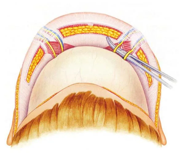 Fig 5. Coronal-brow-lift cadaver dissection: the supratrochlear and supraorbital neurovascular bundles are isolated at the superior orbital rim, the exact structures a deep medial-brow or glabellar bolus can enter.