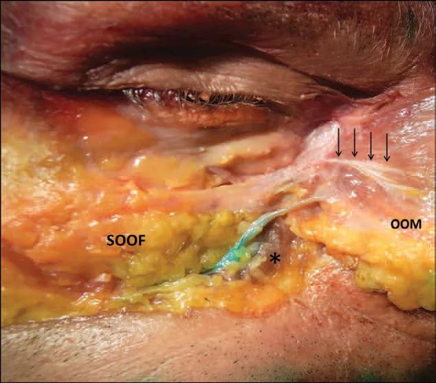 Fig 2. Cadaver dissection of the right infraorbital region: the sub-orbicularis oculi fat (SOOF, yellow) lies deep to the reflected orbicularis oculi muscle (OOM); the dye-marked structure (asterisk) sits at the ligamentous boundary between the SOOF pocket and the tethered medial zone.