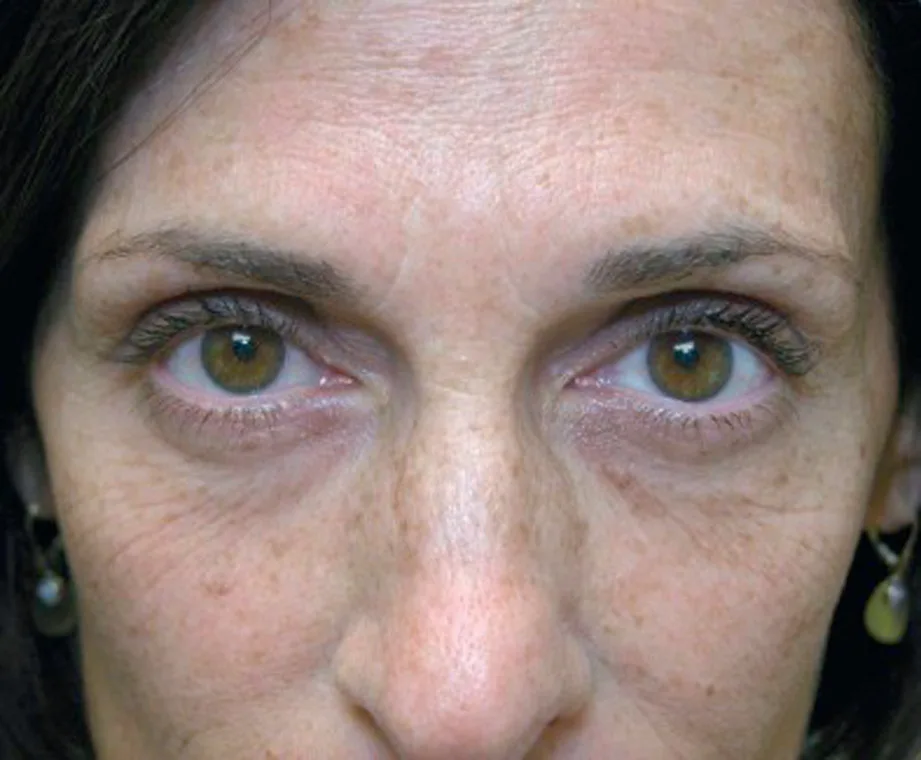 Fig 6. Older patient with a mixed infraorbital presentation: bilateral tear-trough hollowing, periorbital hyperpigmentation and early lower-lid skin laxity, the combination that must be decomposed into its pigment, vascular, shadow and structural components before any single treatment is chosen.