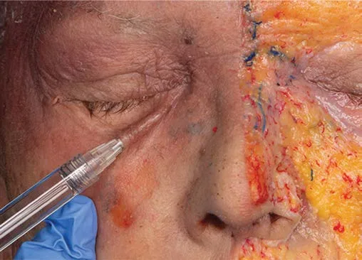 Fig 4. Cadaver of the infraorbital region with a needle entering at the tear trough and the regional arteries dye-marked (red) across the midface, showing how close the medial injection point sits to the angular and infraorbital vessels.