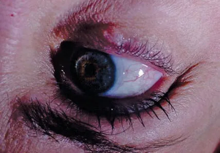 Fig 9. Lower-eyelid toxin technique: the lid skin is pulled taut and a superficial pretarsal aliquot is placed at the mid-pupillary line, 2-3 mm below the margin, raising a small wheal that confirms the correct intradermal depth.