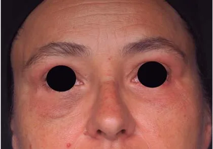 Fig 10. Persistent malar edema after infraorbital filler: bilateral boggy malar fullness below the lid-cheek junction, present more than three years after injection, the region's signature and often refractory complication.