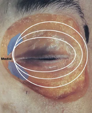 Fig 3. The "aviator-glasses" orbicularis oculi drawn over the eye; the shaded medial zone marks where the muscle is firmly adherent to the bony rim (intramuscular deposition risk), while the concentric outer rings glide over the SOOF.