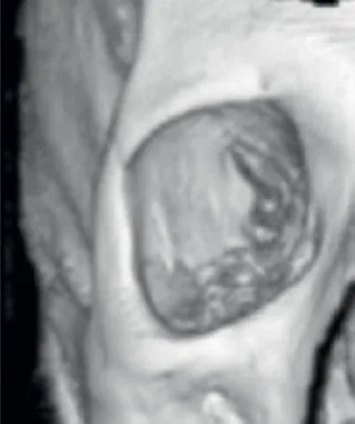 Fig 5. Bony orbit in age: the orbital aperture has widened (supero-medial and infero-lateral rim recession), removing the skeletal platform under the medial brow and lid and producing relative enophthalmos.