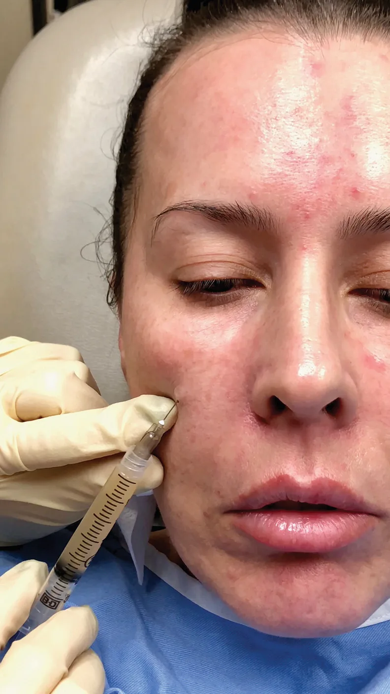 Fig 8. Regenerative infraorbital treatment: platelet-rich plasma delivered to the infraorbital region to improve skin quality, colour and thickness of the thin lower-lid skin, the substrate of pigment and vascular dark circles rather than the shadow.