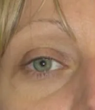 Fig 7. Clinical view of the infraorbital region / tear trough, the treatment target: the medial groove and lid-cheek transition where a small supraperiosteal deposit restores convexity when the phenotype is a structural shadow.