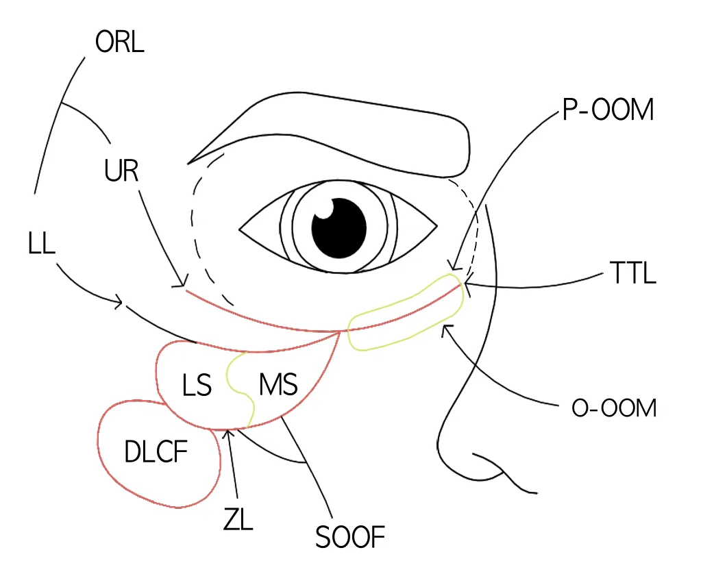 Fig 1. Schematic of the infraorbital ligamentous frame: orbicularis retaining ligament (ORL) with its upper (UR) and lower (LL) limbs, tear-trough ligament (TTL, yellow), the pretarsal (P-OOM) and orbital (O-OOM) orbicularis, the medial (MS) and lateral (LS) segments of the SOOF, the deep lateral cheek fat (DLCF) and the zygomatic ligament (ZL).