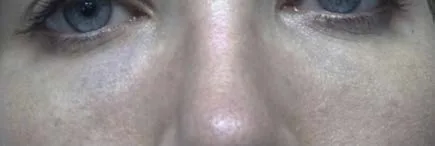 Fig 11. Bilateral Tyndall effect: a blue-grey hue in the infraorbital region after superficial hyaluronic acid, the light-scattering artefact of gel placed too close to the surface in sub-millimetre skin.
