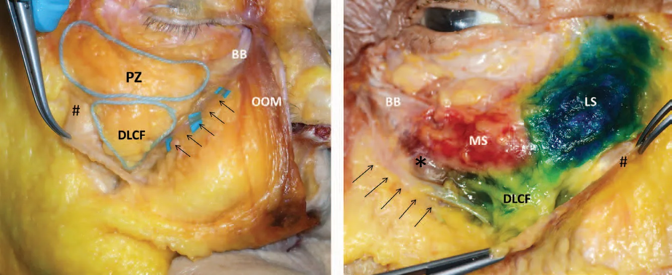 Fig 3. Cadaver infraorbital dissection, deep plane (layer 4/5). PZ = prezygomatic space outlined; DLCF = deep lateral cheek fat; BB = orbital retaining boundary; OOM = orbicularis oculi muscle. Right panel: MS (medial) and LS (lateral) SOOF dyed separately, DLCF below, confirming discrete deep pockets over the zygoma.
