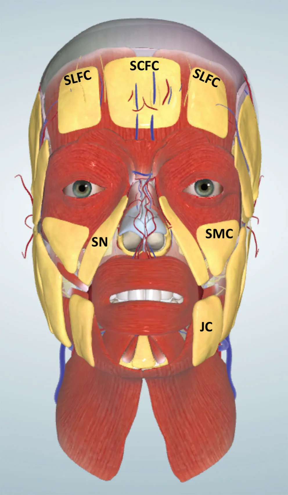 Fig 2. Virtual model, frontal view, superficial fat compartments of the midface. Labels: superficial lateral (SLFC) and superficial central (SCFC) forehead compartments above; the superficial nasal (SN) and superficial middle-cheek (SMC) compartments framing the midface; the jowl compartment (JC) below. The malar target is the deep plane beneath these.