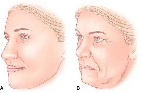 Fig 8. Clinical ageing of the midface, oblique view. (A) youthful cheek with a smooth convex Ogee curve and a short lid-cheek junction. (B) aged: flattened malar projection, a lengthened and hollow lid-cheek junction, a deepened nasojugal groove and early jowling. The change is deflation-first, then descent.