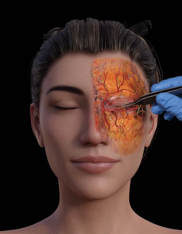 Fig 6. Split-face model of the malar region: intact skin on the left, the right midface dissected and the malar fat pad reflected with forceps to reveal the infraorbital neurovascular bundle and the mid-cheek vascular network. The density of vessels under the cheek is the argument for aspiration and low-pressure delivery.