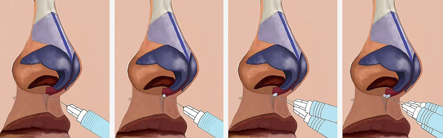 Fig 4. Sagittal sequence of the R4P columella (Point 4) deposit: the syringe enters the base of the columella in the midline, perpendicular to the nasal spine, delivering a supraperiosteal microbolus that builds the tip-support pillar.