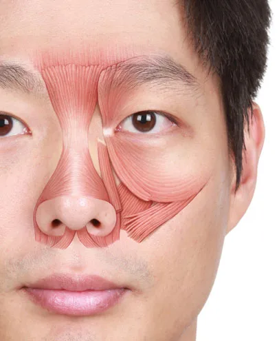 Fig 5. Nasal and perinasal musculature (left overlay): procerus, transverse and alar nasalis, levator labii superioris alaeque nasi, depressor septi nasi and dilatores naris, the toxin targets of the nose.